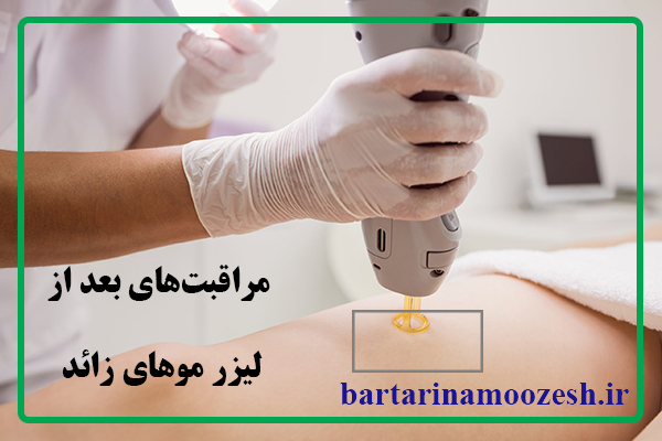 مراقبت های بعد از لیزر موهای زائد