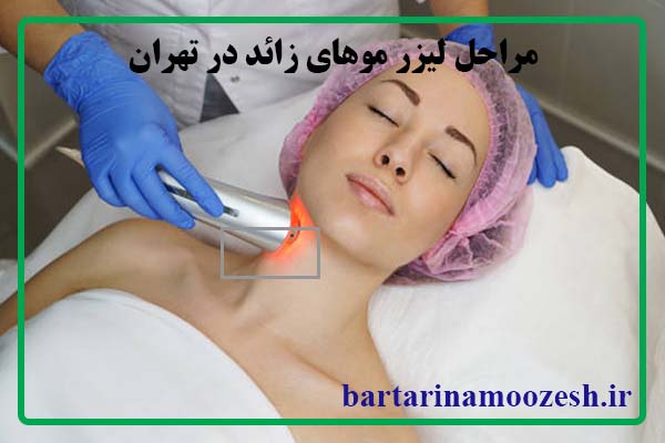 لیزر موهای زائد