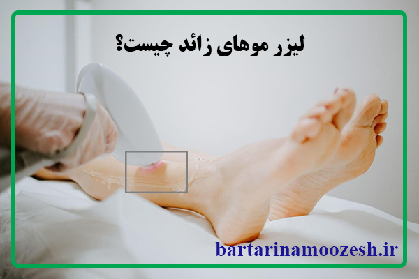 لیزر موهای زائد